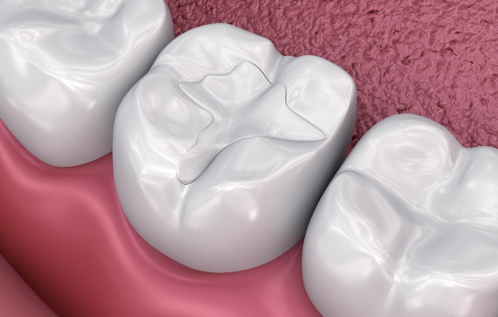 close up of dental filling | dental filling cheshire ct