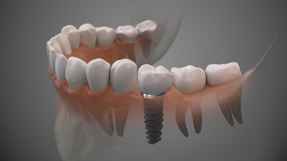 side view of dental implant in jaw | dental implants cheshire ct