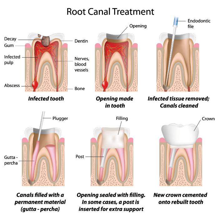 infographic of root canal infection | root canal cheshire