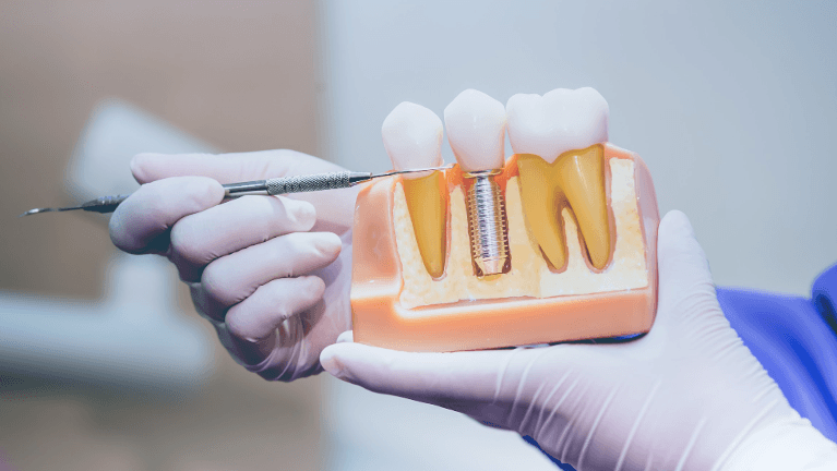 side view of dental implant in jaw | dental implants cheshire ct
